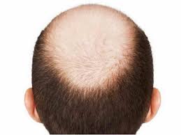 baldness causes